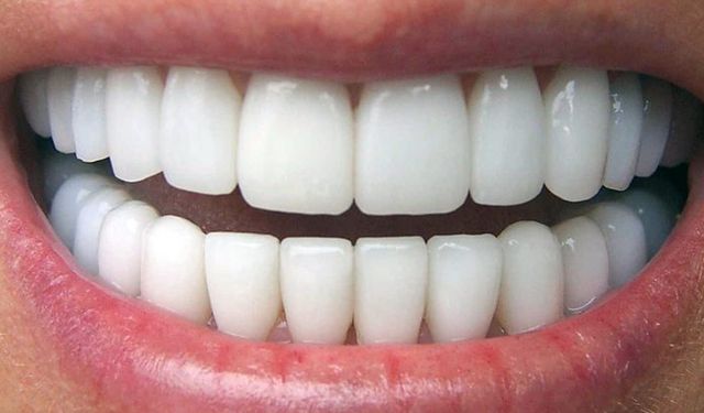 Porselen diş nedir?