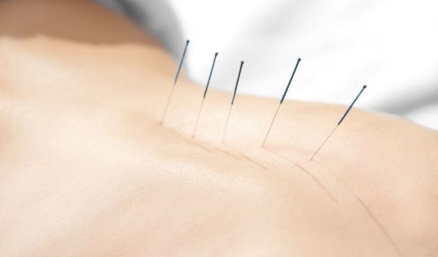 Akupunktur nedir? Nasıl yapılır?